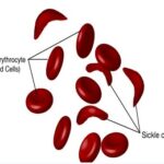 Global congress to intensify fight against sickle cell disease in Nigeria. Event seeks collaboration, innovation for high-burden nation.